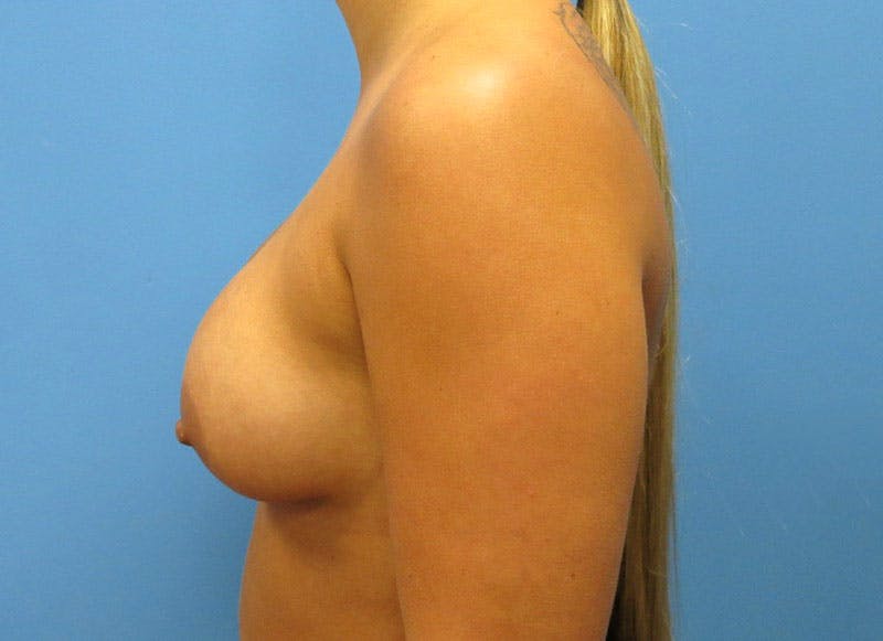 Augmentation Before & After Gallery - Patient 112338642 - Image 2