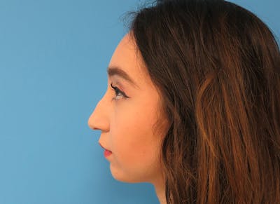 Rhinoplasty Before & After Gallery - Patient 112338654 - Image 1