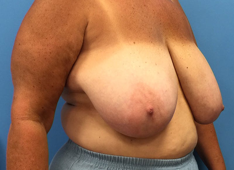 Breast Lift Before & After Gallery - Patient 112338656 - Image 7