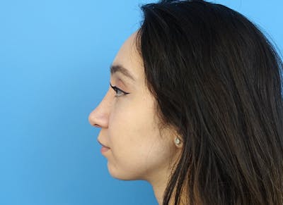 Rhinoplasty Before & After Gallery - Patient 112338654 - Image 2