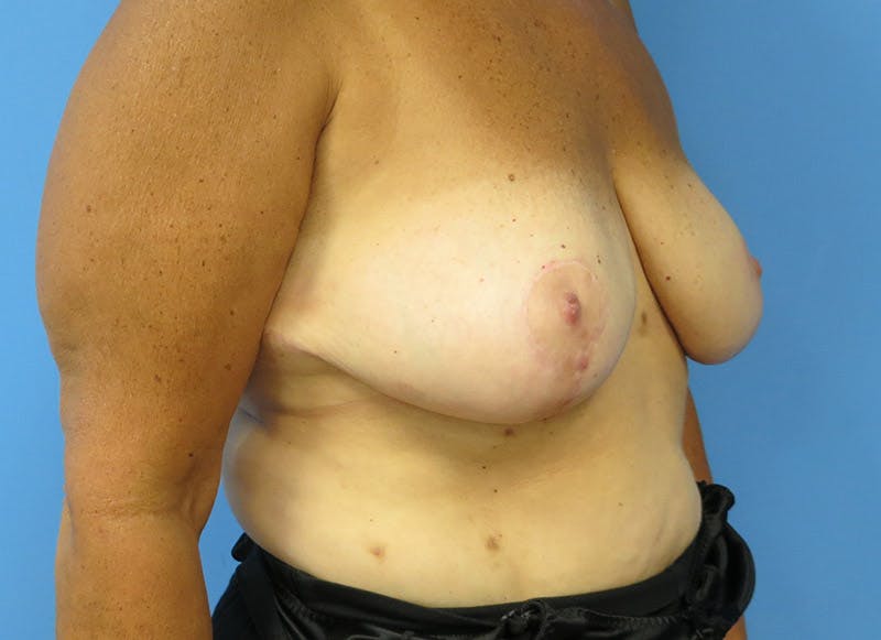 Breast Lift Before & After Gallery - Patient 112338656 - Image 8