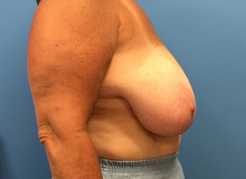Breast Lift Before & After Gallery - Patient 112338656 - Image 9