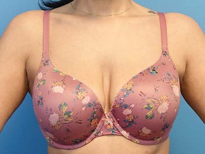 Axillary Breast Removal Before & After Gallery - Patient 112338646 - Image 2