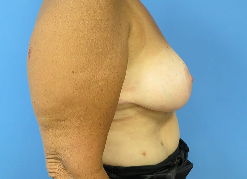 Breast Lift Before & After Gallery - Patient 112338656 - Image 10