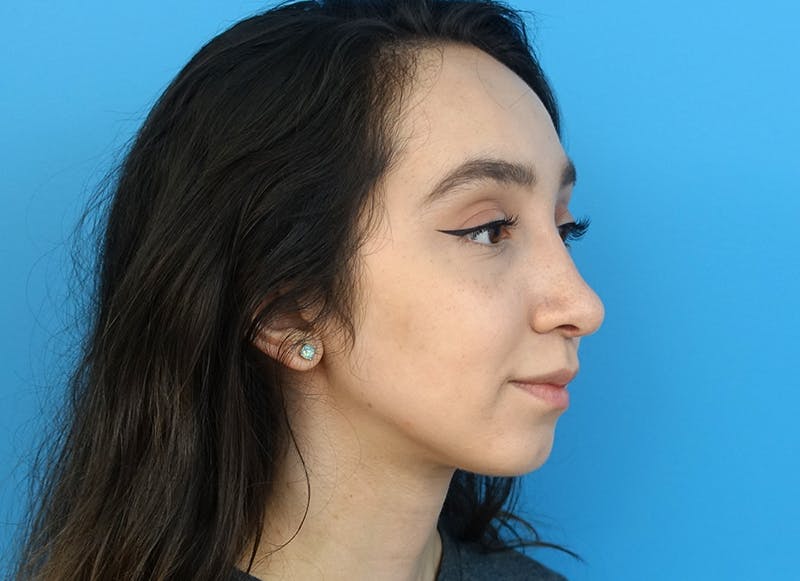 Rhinoplasty Before & After Gallery - Patient 112338654 - Image 8