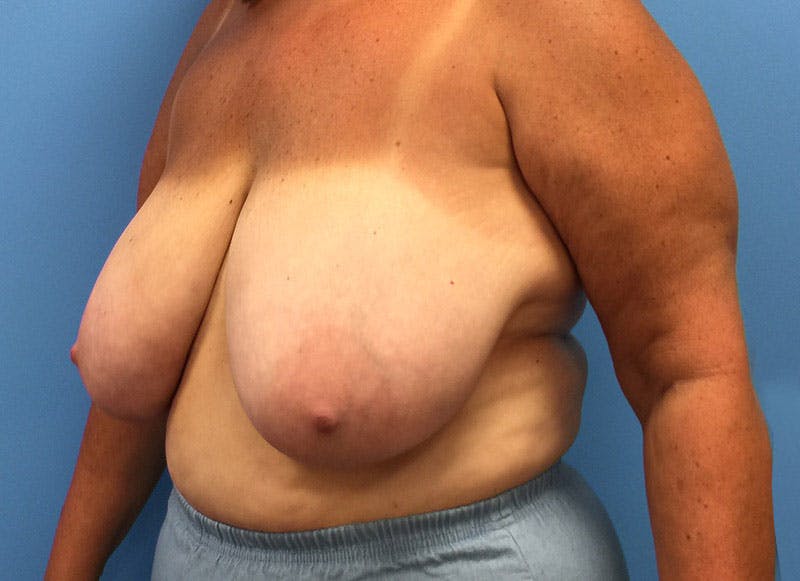 Breast Lift Before & After Gallery - Patient 112338656 - Image 3