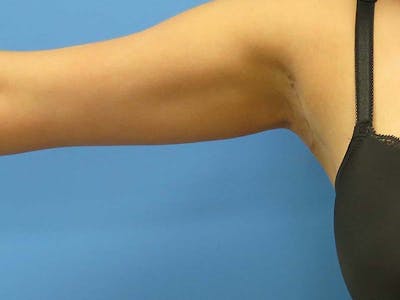 Axillary Breast Removal Before & After Gallery - Patient 407890 - Image 2