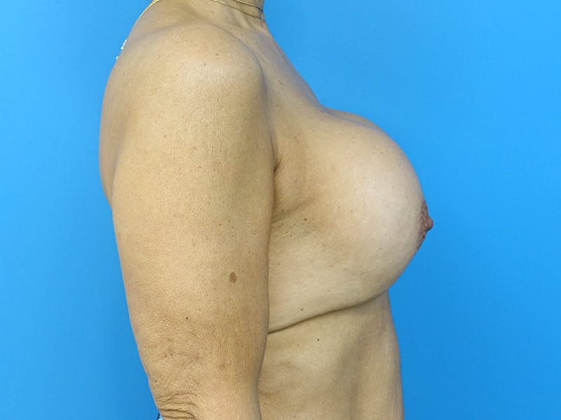 Implant Removal Before & After Gallery - Patient 112338659 - Image 9