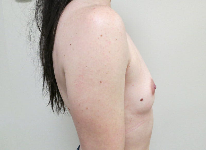 Augmentation Before & After Gallery - Patient 112338661 - Image 9