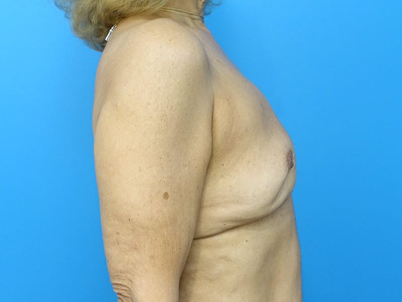 Implant Removal Before & After Gallery - Patient 112338659 - Image 10