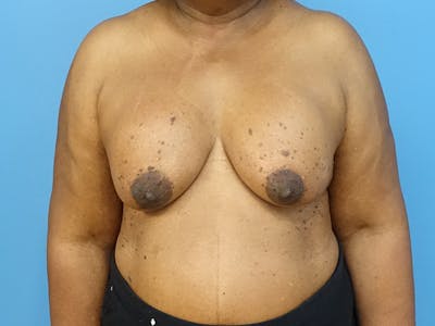 Implant Removal Before & After Gallery - Patient 112338667 - Image 5