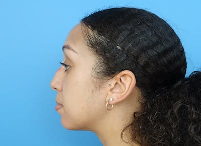 Rhinoplasty Before & After Gallery - Patient 112338668 - Image 1