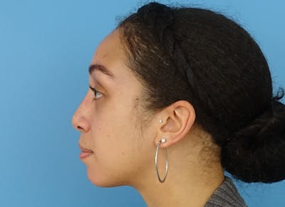 Rhinoplasty Before & After Gallery - Patient 112338668 - Image 2
