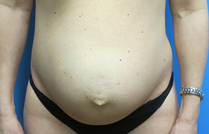 Abdominoplasty Before & After Gallery - Patient 112338666 - Image 5