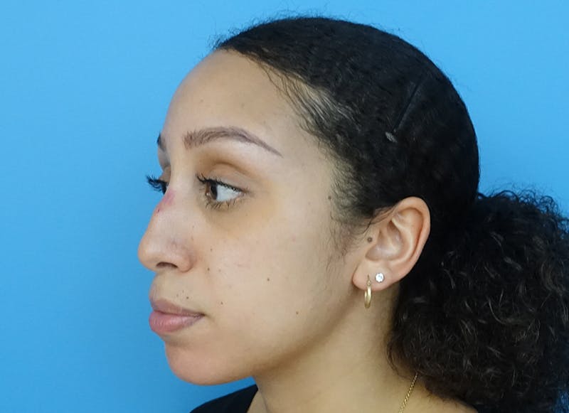 Rhinoplasty Before & After Gallery - Patient 112338668 - Image 3