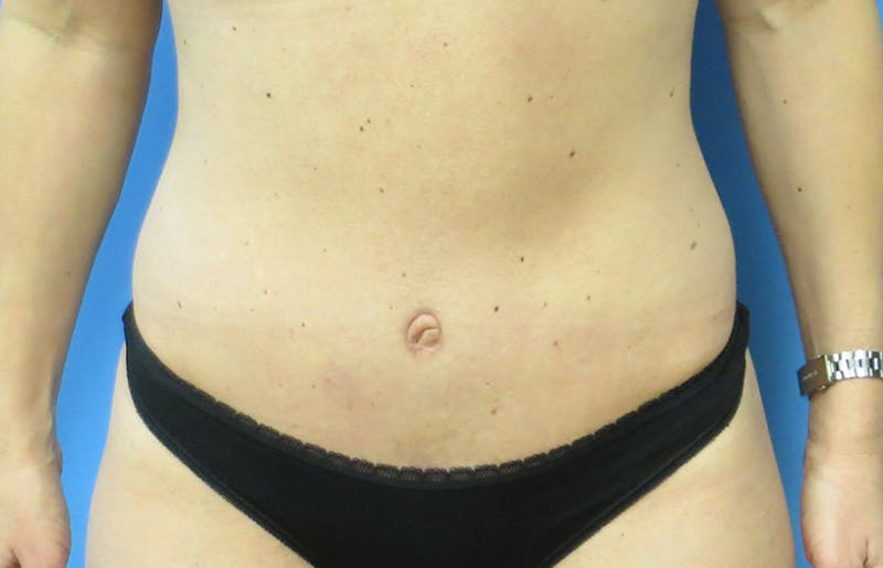 Abdominoplasty Before & After Gallery - Patient 112338666 - Image 6