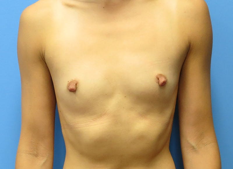 Augmentation Before & After Gallery - Patient 112338669 - Image 5