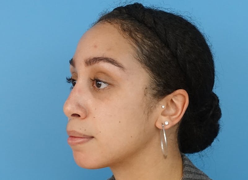 Rhinoplasty Before & After Gallery - Patient 112338668 - Image 4
