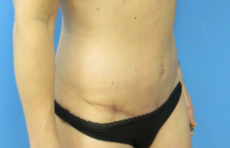 Abdominoplasty Before & After Gallery - Patient 112338666 - Image 8