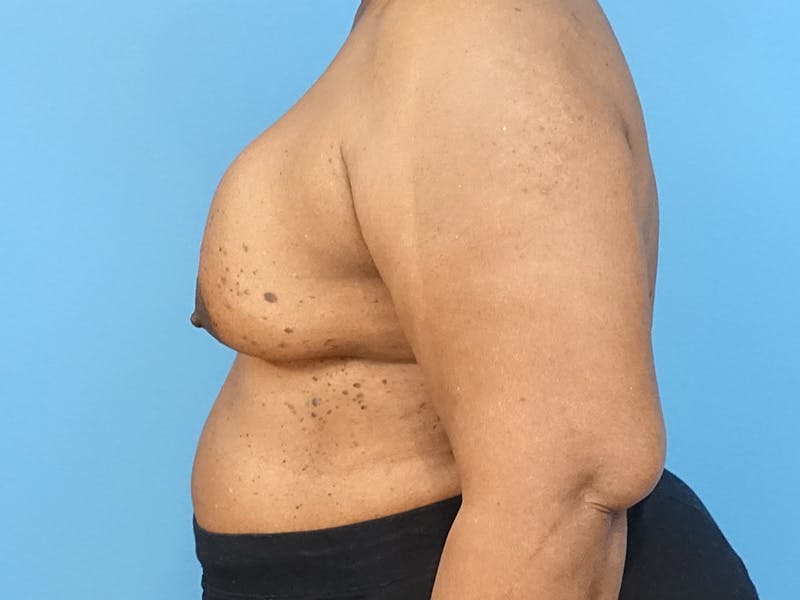 Implant Removal Before & After Gallery - Patient 112338667 - Image 1