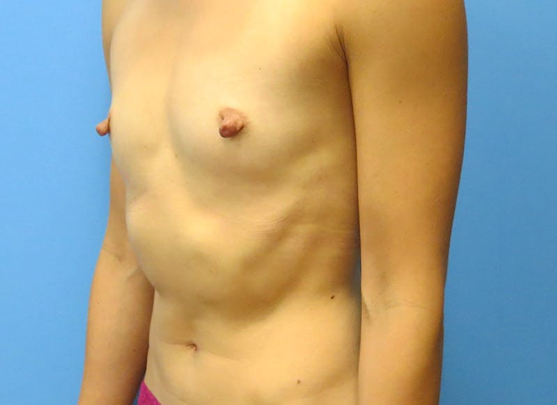 Augmentation Before & After Gallery - Patient 112338669 - Image 3