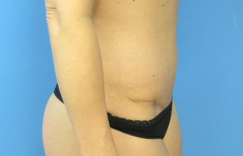 Abdominoplasty Before & After Gallery - Patient 112338666 - Image 10