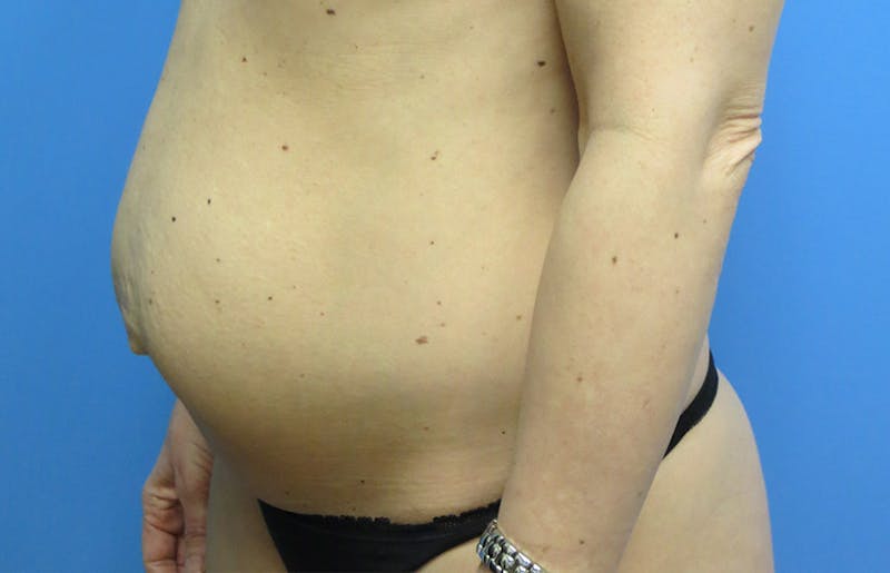 Abdominoplasty Before & After Gallery - Patient 112338666 - Image 3