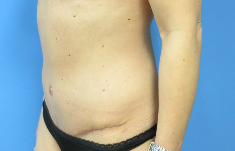 Abdominoplasty Before & After Gallery - Patient 112338666 - Image 4