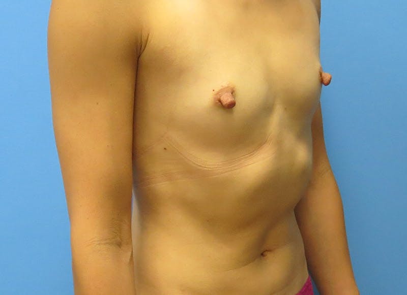 Augmentation Before & After Gallery - Patient 112338669 - Image 7