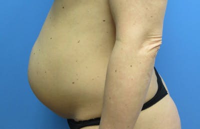 Abdominoplasty Before & After Gallery - Patient 112338666 - Image 1