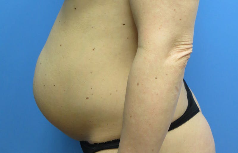 Abdominoplasty Before & After Gallery - Patient 112338666 - Image 1