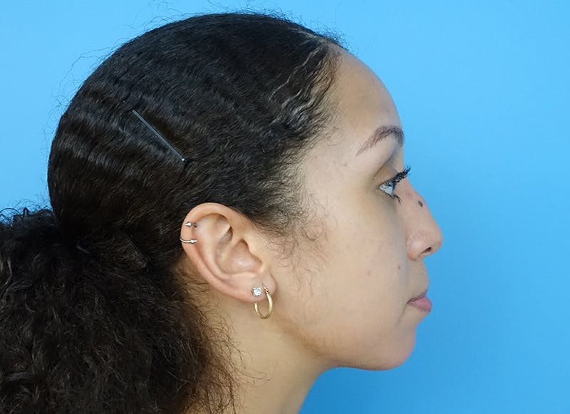 Rhinoplasty Before & After Gallery - Patient 112338668 - Image 9