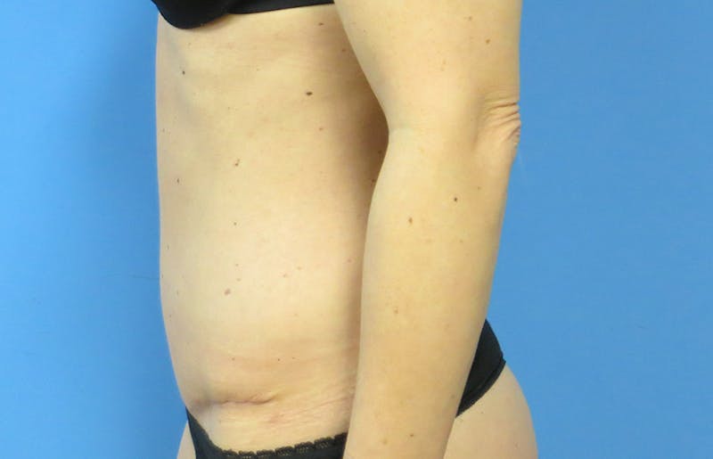 Abdominoplasty Before & After Gallery - Patient 112338666 - Image 2