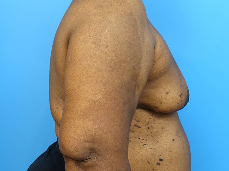 Implant Removal Before & After Gallery - Patient 112338667 - Image 10