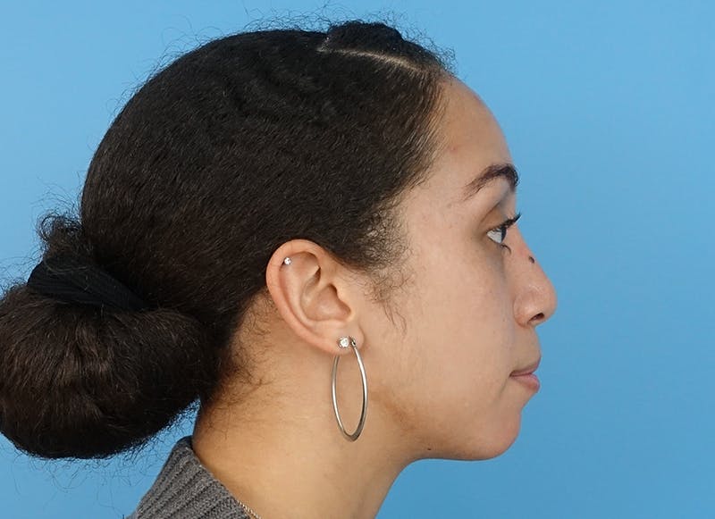 Rhinoplasty Before & After Gallery - Patient 112338668 - Image 10