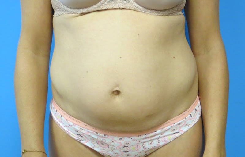 Abdominoplasty Before & After Gallery - Patient 112338672 - Image 5
