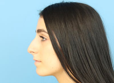 Rhinoplasty Before & After Gallery - Patient 112338679 - Image 1