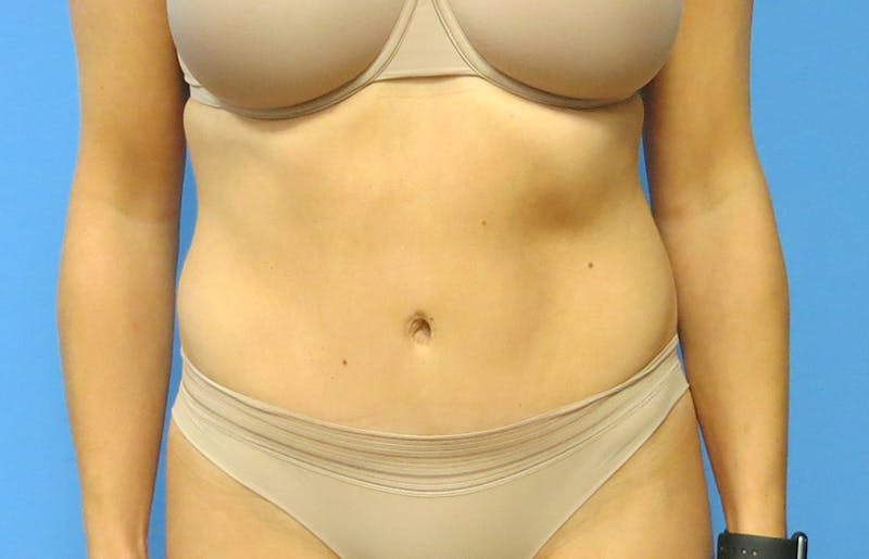Abdominoplasty Before & After Gallery - Patient 112338672 - Image 6