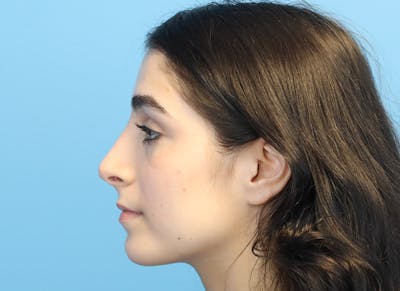 Rhinoplasty Before & After Gallery - Patient 112338679 - Image 2
