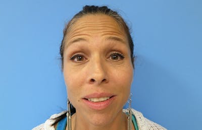 Botox Before & After Gallery - Patient 112338670 - Image 1