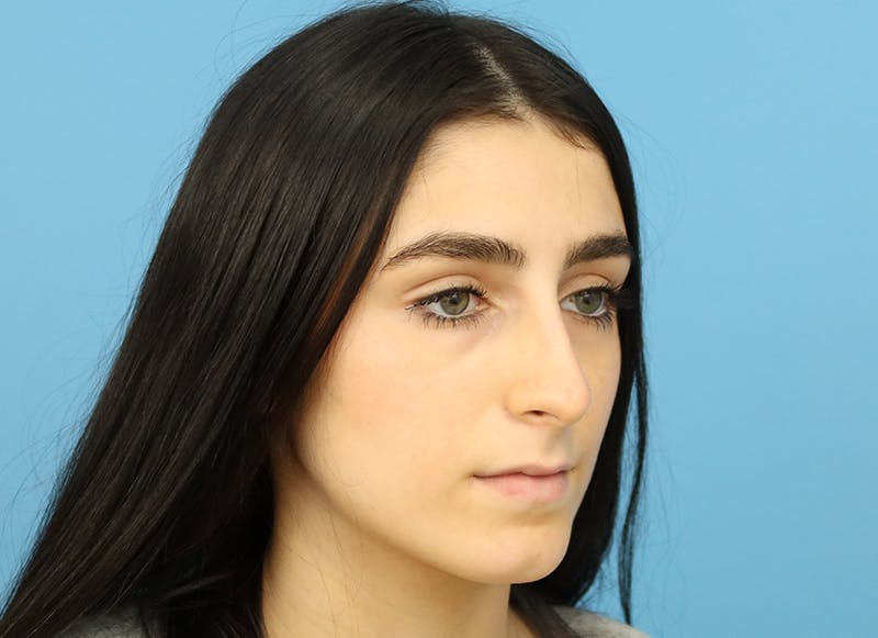 Rhinoplasty Before & After Gallery - Patient 112338679 - Image 7