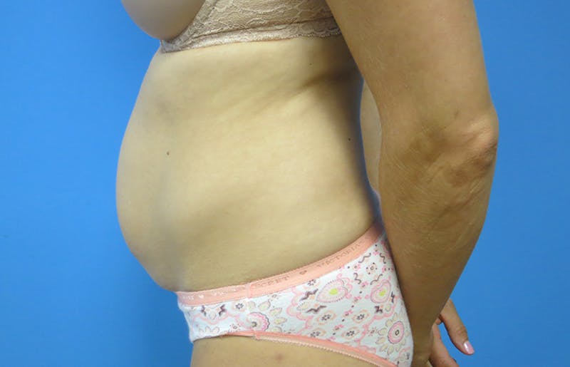 Abdominoplasty Before & After Gallery - Patient 112338672 - Image 1