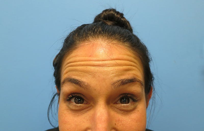 Botox Before & After Gallery - Patient 112338673 - Image 1