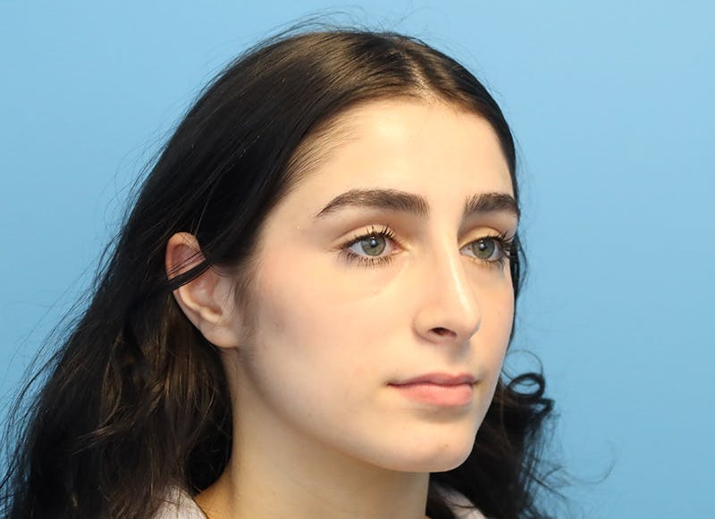 Rhinoplasty Before & After Gallery - Patient 112338679 - Image 8