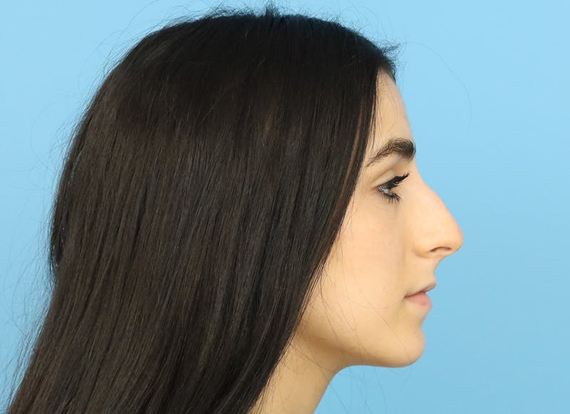 Rhinoplasty Before & After Gallery - Patient 112338679 - Image 9