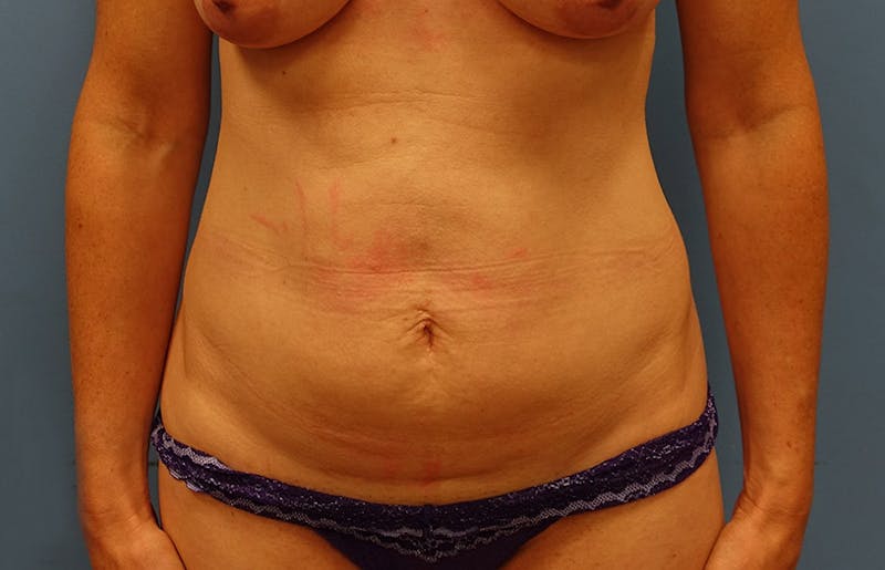 Abdominoplasty Before & After Gallery - Patient 112338682 - Image 5