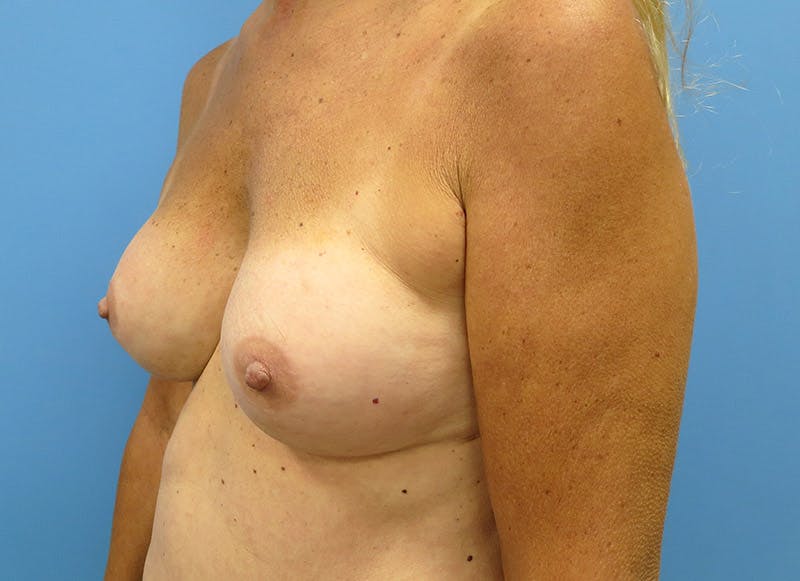 Augmentation Before & After Gallery - Patient 112338676 - Image 3