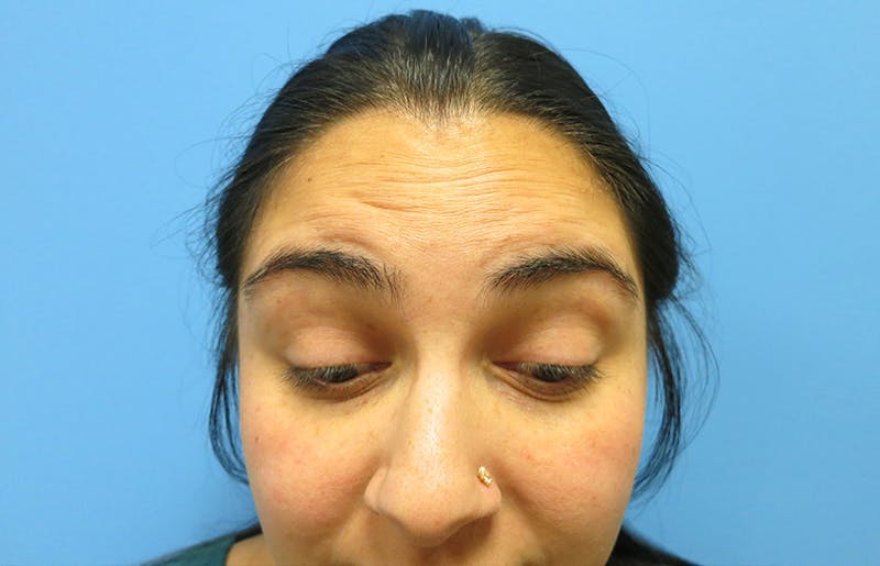 Botox Before & After Gallery - Patient 112338675 - Image 1