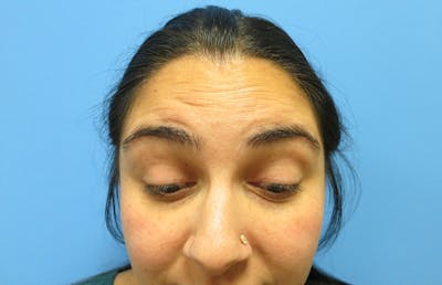 Botox Before & After Gallery - Patient 112338675 - Image 1