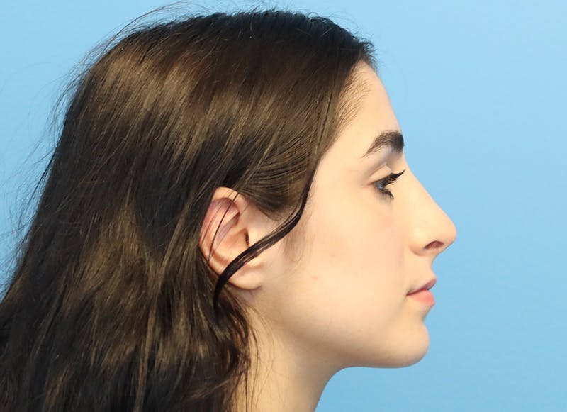 Rhinoplasty Before & After Gallery - Patient 112338679 - Image 10